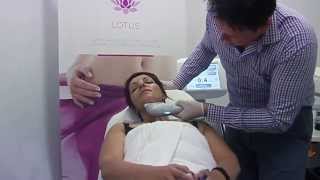 Ultraformer  Nonsurgical Face and Neck Lifting [upl. by Mitchiner759]