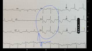 ECG week 20 STEMI OR NSTEMI [upl. by Modnar]