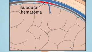 Understanding Subdural Hematoma [upl. by Dutchman]