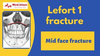 Le Fort I Fracture l Mid face fracture l Oral surgery l Mediklaas [upl. by Nelleoj]