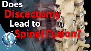 Does Discectomy Lead to Spinal Fusion [upl. by Angeline848]