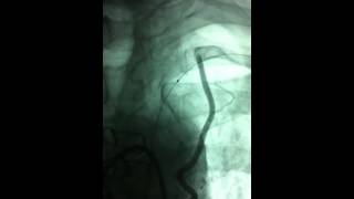 Subclavian artery total occlusion and stenting [upl. by Ahsenyt]