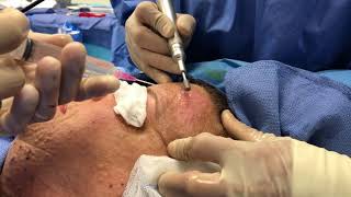 Surgeon Explains Dermabrasion for Cutaneous Neurofibromas [upl. by Arej]