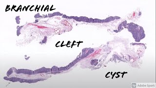 Branchial Cleft Cyst 5Minute Pathology Pearls [upl. by Arrimat502]