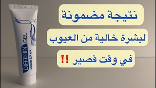 طريقة استخدام ديفرين جل  الحل الفعال للتخلص من العيوب الجلديه في اسرع وقت  Differin Gel [upl. by Dory]