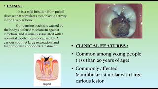 condensing osteitis [upl. by Artcele]