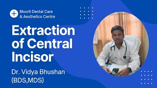 Extraction of Central Incisor and Root Stump Dental Extraction Tutorial  Dr Vidya Bhushan [upl. by Cumings]