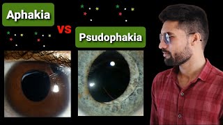 Aphakia  Psudophakia lecture opthalmology [upl. by Valdis976]