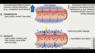 PATHOLOGY LECTURES  Hemodynamic Disorder  EXUDATES and TRANSUDATES [upl. by Sommers652]