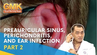 Preauricular Sinus Perichondritis and Ear Infection Part 2  Usapang Pangkalusugan [upl. by Alegnatal983]