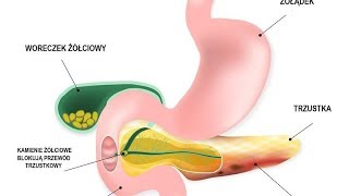 OSTRE ZAPALENIE TRZUSTKI  objawy i leczenie [upl. by Eeleimaj]