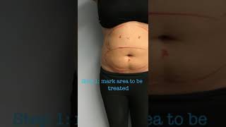 Full CoolSculpting Treatment with Before and Afters [upl. by Aietal]