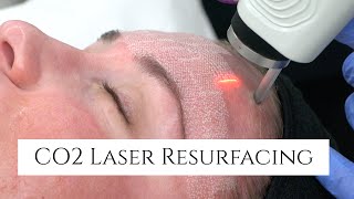 CO2 Laser Facial Rejuvenation  Fix Fine Lines and Wrinkles  Fix Sun Damage  Fix Stretch Marks [upl. by Dnivra317]