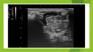 Echographie dun kyste poplité bursite du semi membraneux [upl. by Geanine576]