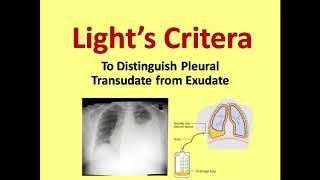 Lights Criteria for Distinguishing Transudate from Exudate [upl. by Yanehs]