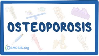 Osteoporosis  causes symptoms diagnosis treatment pathology [upl. by Kipp529]