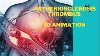 Atherosclerosis thrombus formation 3d Animation [upl. by Retsae]