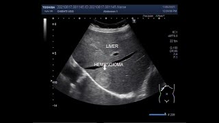 Multiple cases of Hepatic Hemangiomas [upl. by Annaeg85]