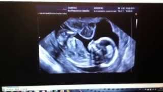 Amazing Ultrasound 15 weeks  Baby drinking fluid [upl. by Cirone825]