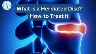 What is a Herniated Disc Howto Treat it [upl. by Beckie863]