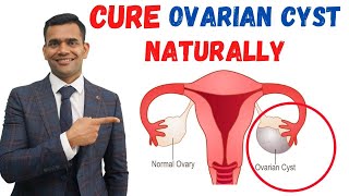 Just 3 Recommendations To Cure Ovarian Cyst Naturally  Dr Vivek Joshi [upl. by Atisusej]