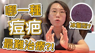 什麼是冰鑿型痘疤？冰鑿型痘疤如何形成？莊盈彥醫師來跟你說如何治療這種嚴重型痘疤！ [upl. by Hooker]