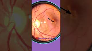 Macular Pathology  macular scar  Fundus Videography  Fundus Photography  Short Video 144 viral [upl. by Enriqueta]