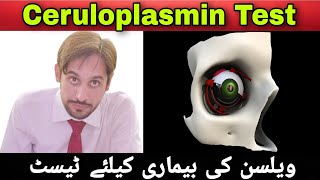 Ceruloplasmin Test  Ceruloplasmin Test in Hindi  Ceruloplasmin Biochemistry [upl. by Nevin]