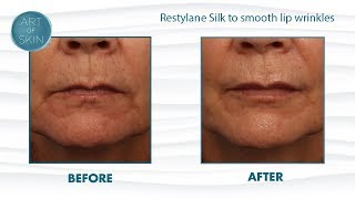 Restylane Silk injection for lips and lip lines [upl. by Keele]