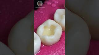 Repairing Dental Caries toothrestoration shorts [upl. by Flatto]