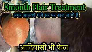 100 hair growth process नये बाल उगाने का treatment  hairgrowth minoxidil [upl. by Norina]