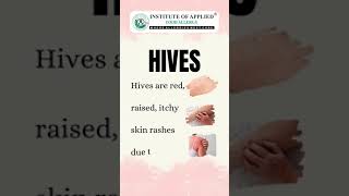 How to Treat Hives Urticaria Naturally shorts [upl. by Ailey]