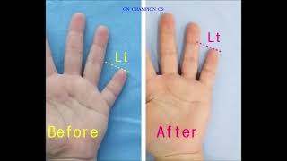 brachydactyly brachydactylytypeD 短指症手術 短指症 マムシ指 しゃもじ指 まむし指 단지증 단지증수술 단지증수술후기 [upl. by Lamond330]