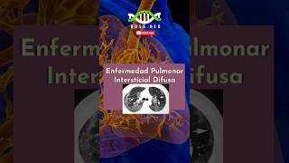 ENFERMEDAD PULMONAR INTERSTICIAL DIFUSA EN 1 Min salud medico doctor mrdoctor pulmones [upl. by Aurilia]