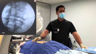 Radiofrequency Ablation Procedure [upl. by Gerty]