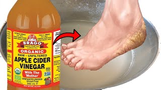 How To Get Rid of Dead Skin Calluses Foot Odor and Fungus on Feet Using Apple Cider Vinegar [upl. by Basham]