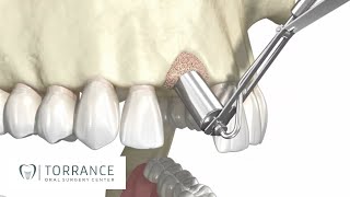 Torrance CA Bone Grafting for Dental Implants  Redondo Beach Tooth Bone Graft [upl. by Enirahtak]