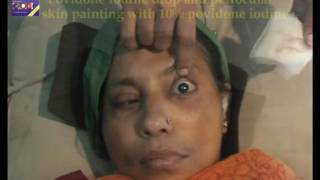 PERIBULBAR BLOCK  Cataract Surgery  DrSamar Basak [upl. by Clifford]