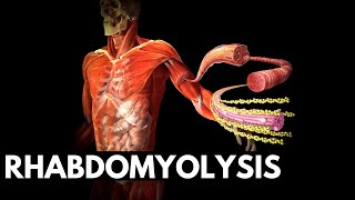 Rhabdomyolysis Unveiled From Muscle Damage to Kidney Risk [upl. by Yrehc]