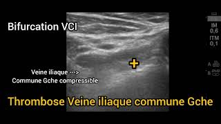 Thrombose veineuse profonde proximale étendue Iliaque Fémorale Membre inférieur Échographie [upl. by Samau]