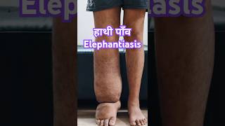 हाथी पांव Elephantiasis ये कौन सी बीमारी है filaria [upl. by Marcell]