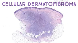 Cellular dermatofibroma dermpath pathology dermatology [upl. by Modestia29]