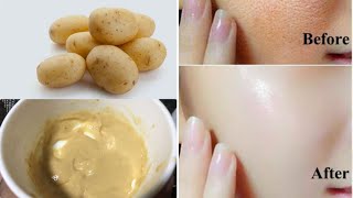 Potato Face Pack For Glowing Skin Pigmentation Acne Scars Clear Skin Beesan face pack [upl. by Atilef]