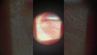 Tear duct  punctal plug insertion [upl. by Najed]