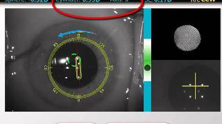 Intraoperative measurement of astigmatism for accurate positioning of IOLs [upl. by Eunice]