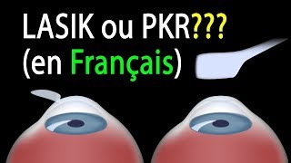 LASIK ou PKR Comparaison des procédures animation [upl. by Lillie]