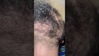 Beard hair removal removingingrown hairissue satisfying ingrownhairremoval hair ingrown [upl. by Ytineres]