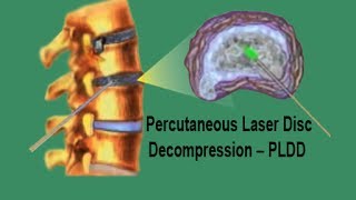 PLDD  Percutaneous Laser Disc Decompression [upl. by Anahcar]