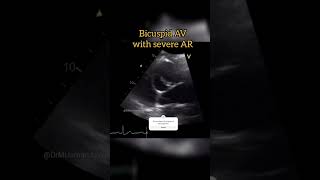 Bicuspid Aortic Valve with Aortic Regurgitation echocardiography cardiology [upl. by Rebliw]