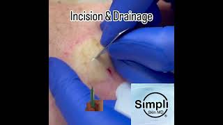 AbscessBoil Incision amp Drainage [upl. by Lordan]